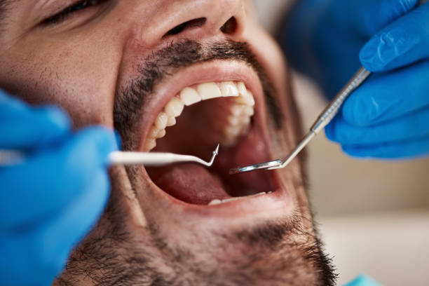 Best Dental Abscess Treatment in Nipomo, CA